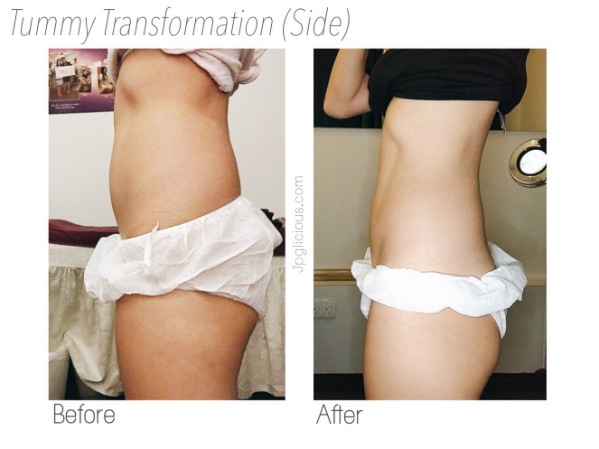 Body Perfect SG Slimming Weight Loss Singapore - Jpglicious Mar 2017 (3)