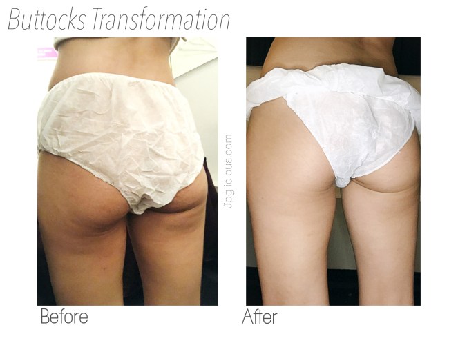 Body Perfect SG Slimming Weight Loss Singapore - Jpglicious Mar 2017 (5)