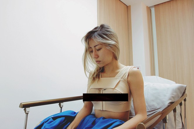 Allure Plastic Surgery Singapore - Breast Augmentation Mentor Impants- Dr Samuel Ho (22)