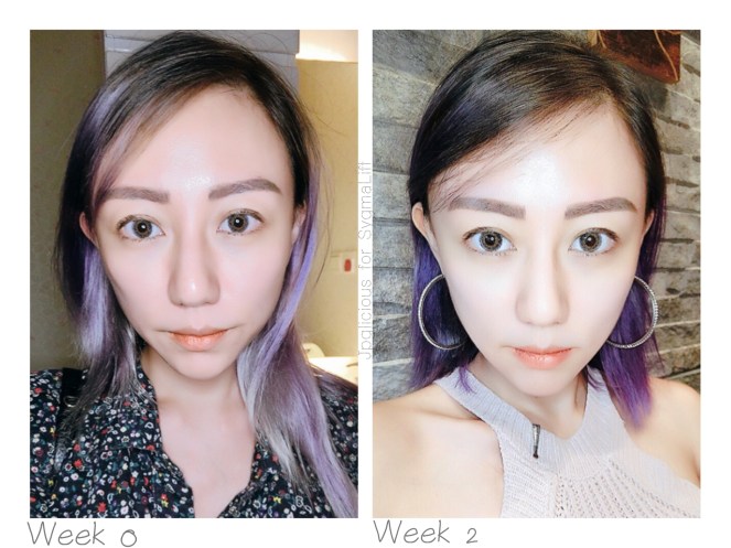 SygmaLift V Contourae Face - Kowayo Aesthetic Clinic Singapore - Jpglicious (11)