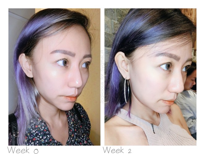 SygmaLift V Contourae Face - Kowayo Aesthetic Clinic Singapore - Jpglicious (12)