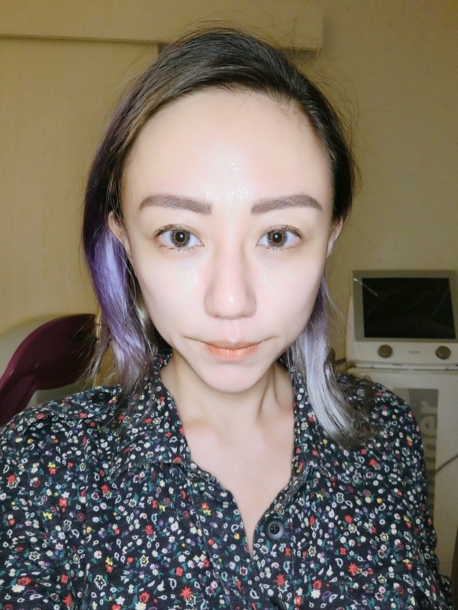 SygmaLift V Contourae Face - Kowayo Aesthetic Clinic Singapore - Jpglicious (5)