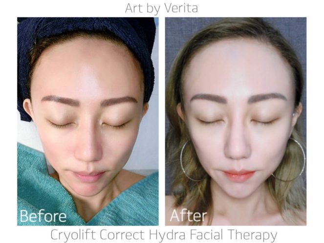 Art by Verita Cryolift Correct Hydra Facial Therapy-MediSpa-Jpglicious (9)