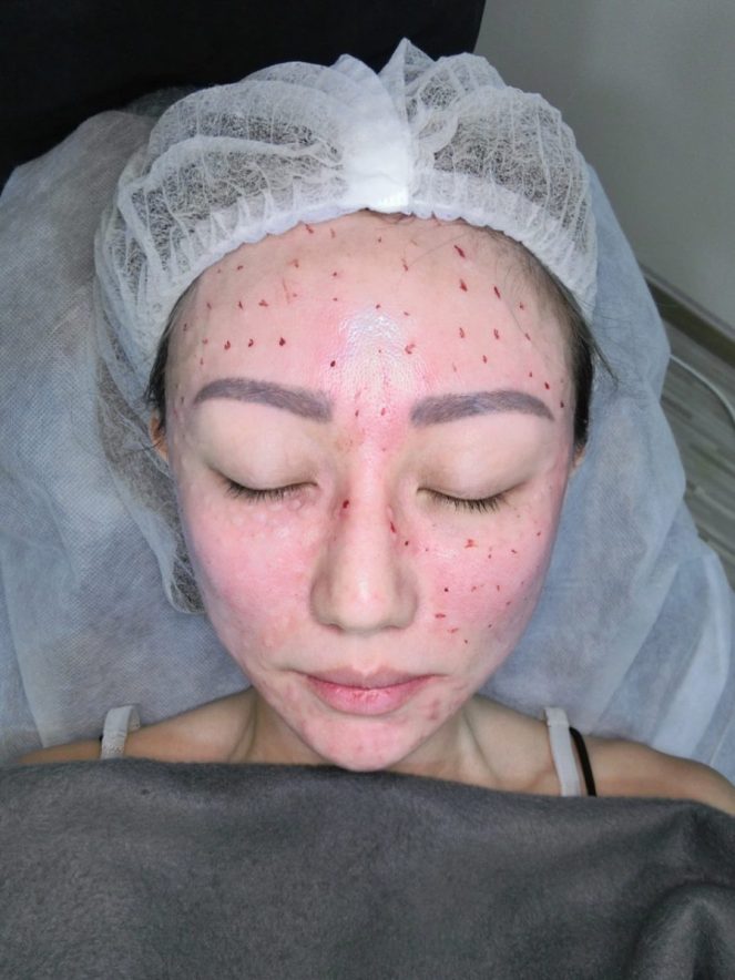 Rejuran-Veritas Medical Aesthetics-Jpglicious (5)