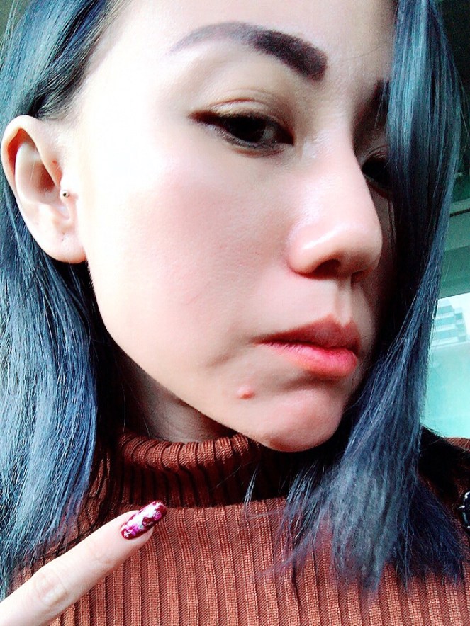 NOVU Medical Aesthetic Clinic Genesis Flagship Store Singapore- Illumi Laser Treatment -Jpglicious (6)