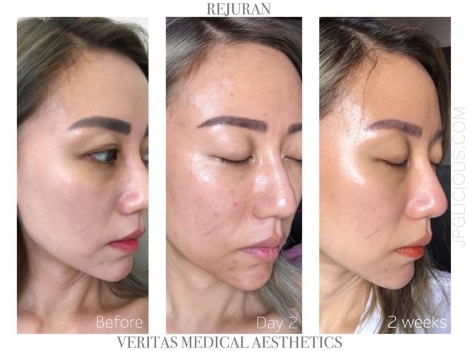 Rejuran-Veritas Medical Aesthetics-Jpglicious (4)