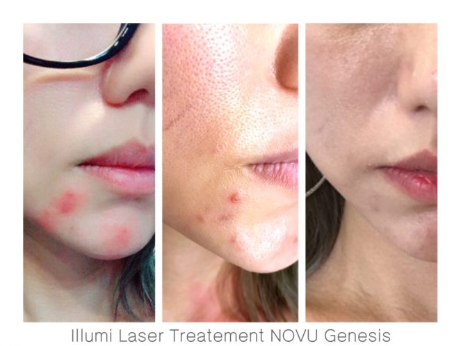 NOVU Medical Aesthetic Clinic Genesis Flagship Store Singapore- Illumi Laser Treatment -Jpglicious (7)