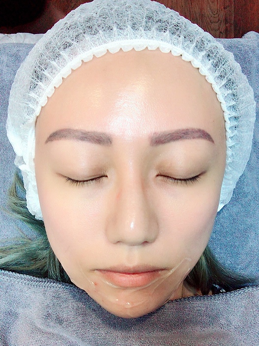 NOVU Medical Aesthetic Clinic Genesis Flagship Store Singapore- Illumi Laser Treatment -Jpglicious (5)